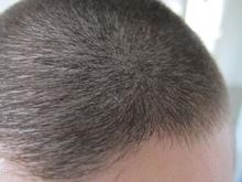 Kortklippet hovedbund på et hankønsmenneske.