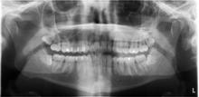 Et røntgenbillede Ortopan (OTP) af hele min mund.