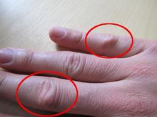 Billede af hårde knopper på lange- og lillefinger